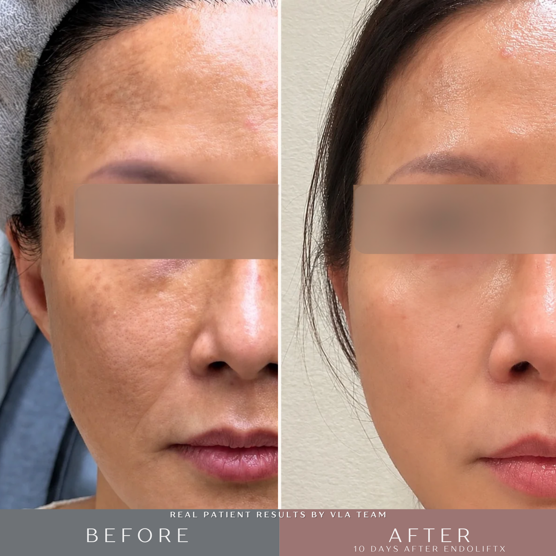 V-Lifting With EndoliftX - Skin Perfect Brothers Powered by VLA