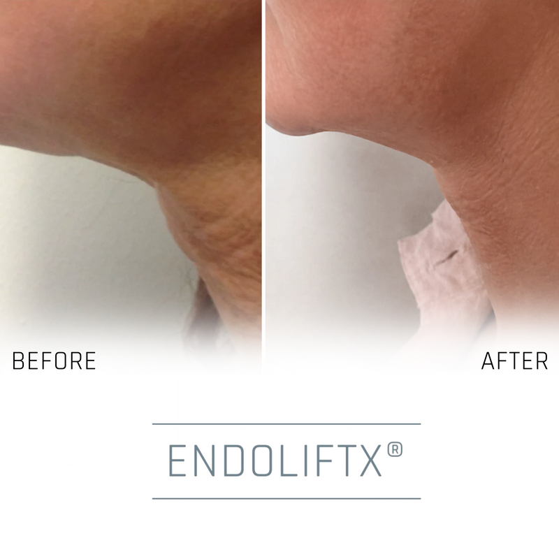 V Lifting with EndoliftX