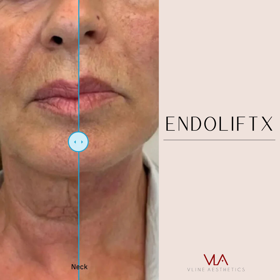 V-Lifting With EndoliftX - Skin Perfect Brothers Powered by VLA
