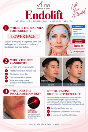 V-Lifting With EndoliftX - Skin Perfect Brothers Powered by VLA