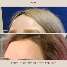 Temple Lift - Skin Perfect Brothers Powered by VLA
