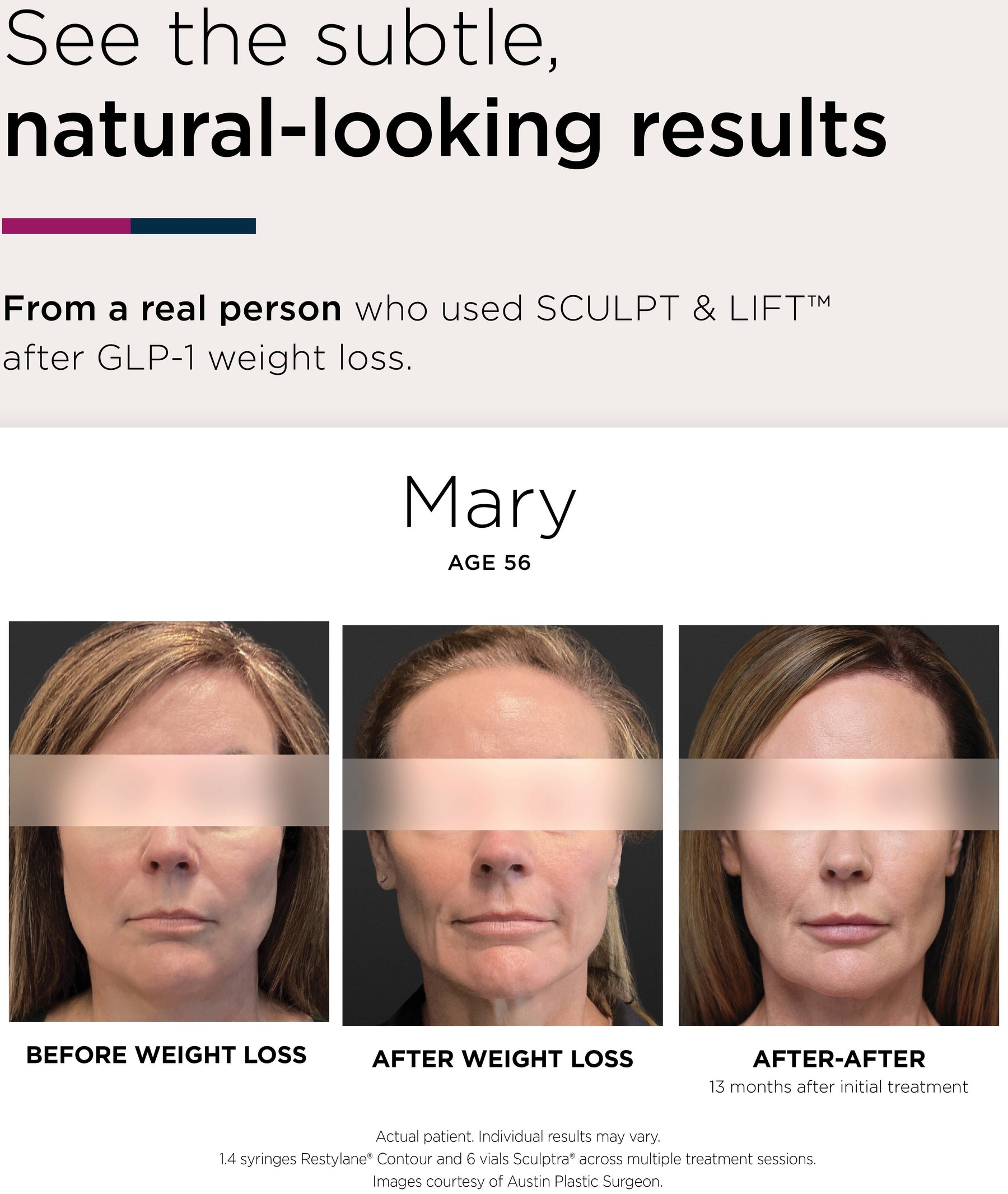 Sculptra - Skin Perfect Brothers Powered by VLA