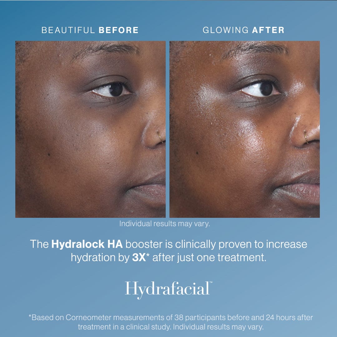 Hydrafacial - Skin Perfect Brothers Powered by VLA
