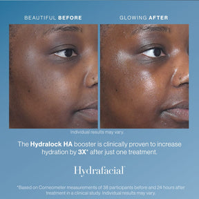 Hydrafacial - Skin Perfect Brothers Powered by VLA