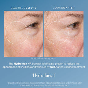 Hydrafacial - Skin Perfect Brothers Powered by VLA