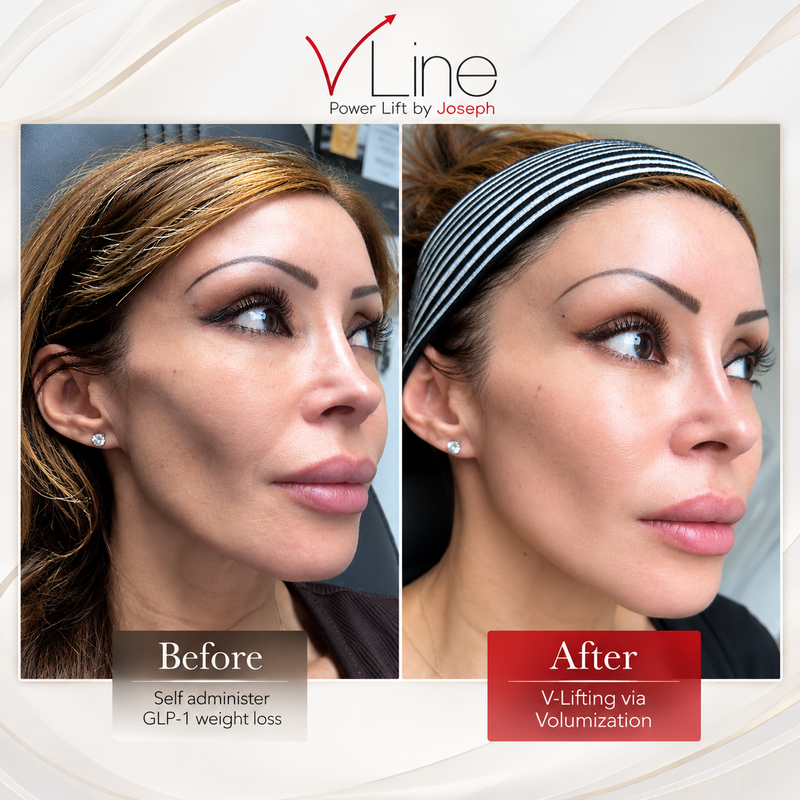V Lifting GLP-1 Ozempic Face 