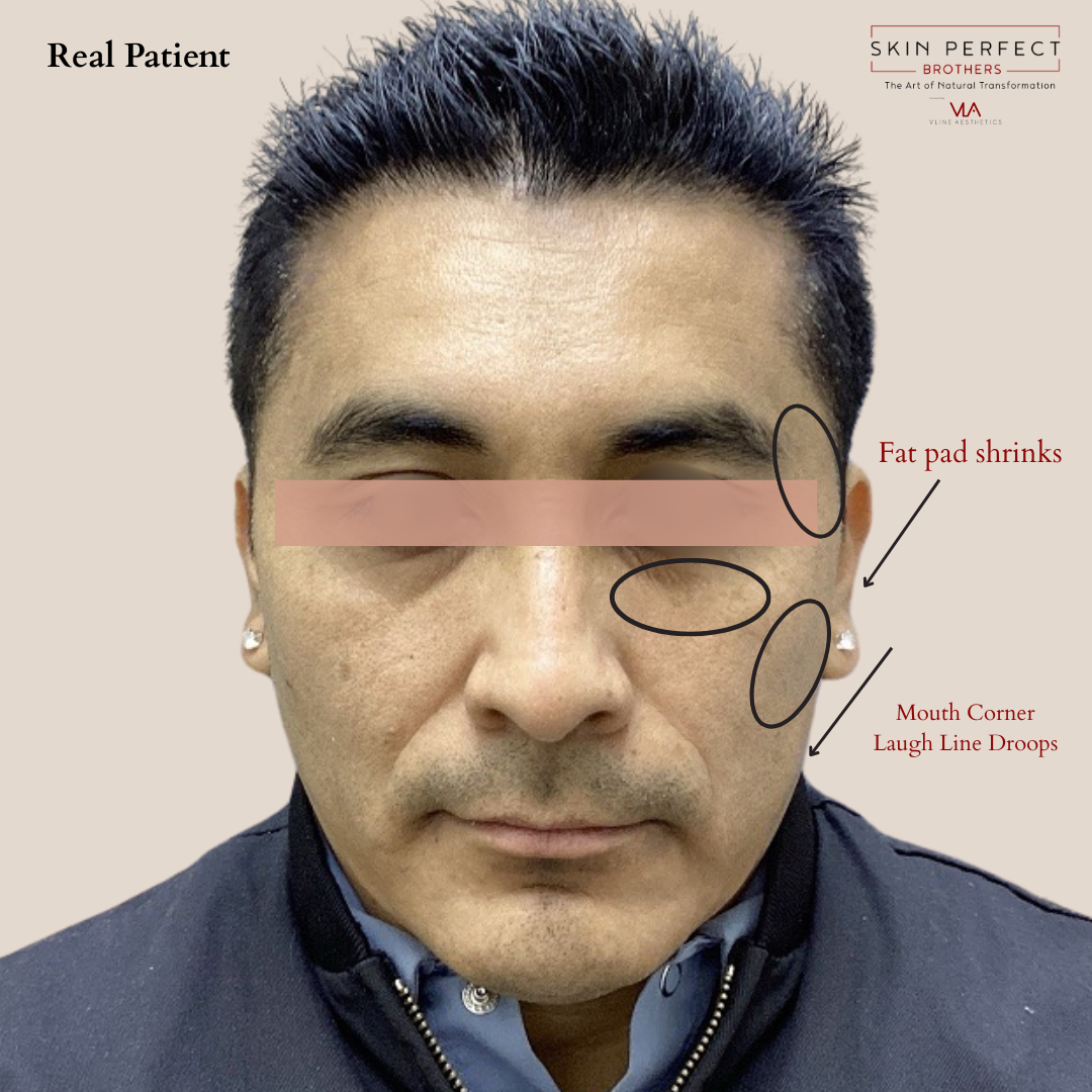 What is "Ozempic Face"?