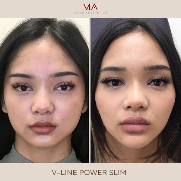 Masseter Injection - Skin Perfect Brothers Powered by VLA
