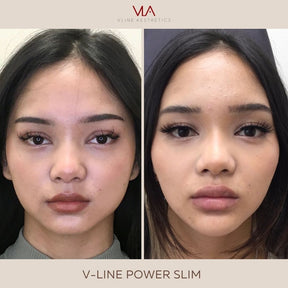 Masseter Injection - Skin Perfect Brothers Powered by VLA