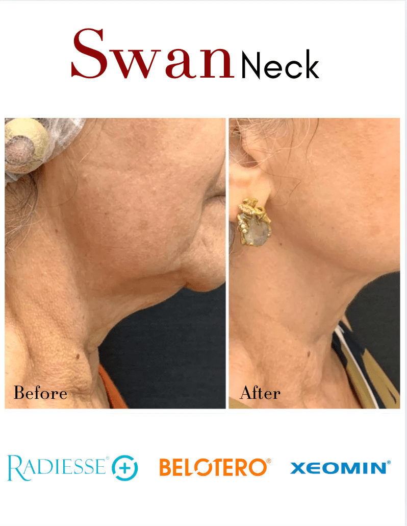 Swan Neck Package - Skin Perfect Brothers Powered by VLA