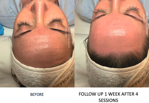 PRX-PLUS - Deep wrinkle / PIH & Melasma correction - Skin Perfect Brothers Powered by VLA