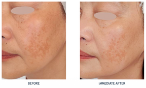 PRX-PLUS - Deep wrinkle / PIH & Melasma correction - Skin Perfect Brothers Powered by VLA