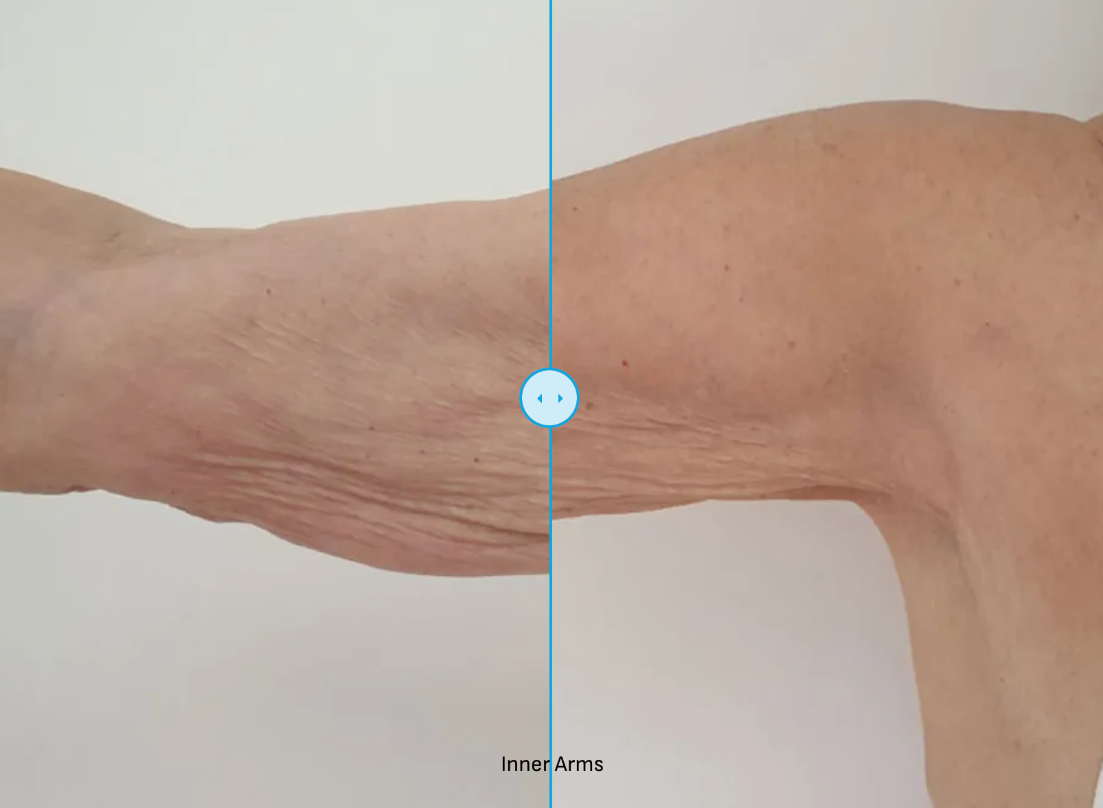 EndoliftX - Skin Perfect Brothers Powered by VLA