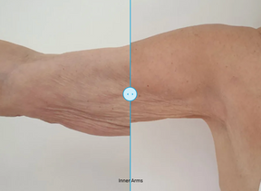 EndoliftX - Skin Perfect Brothers Powered by VLA