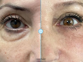 EndoliftX - Skin Perfect Brothers Powered by VLA