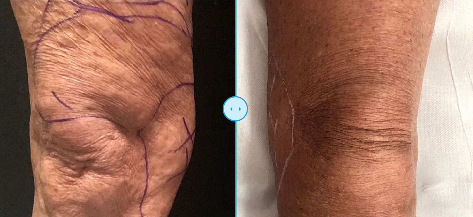 EndoliftX - Skin Perfect Brothers Powered by VLA