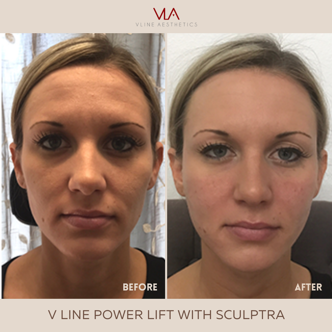 Sculptra - Skin Perfect Brothers Powered by VLA