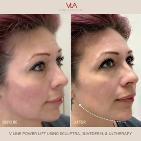 Sculptra - Skin Perfect Brothers Powered by VLA