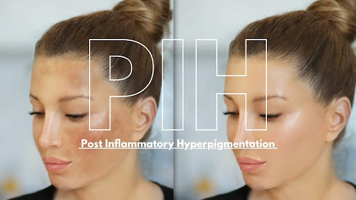 How Inflammation Causes Pigmentation