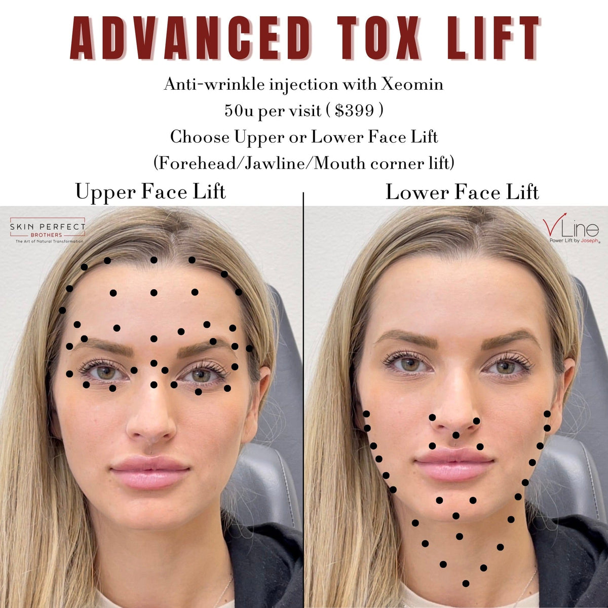 Tox Lift - Skin Perfect Brothers Powered by VLA