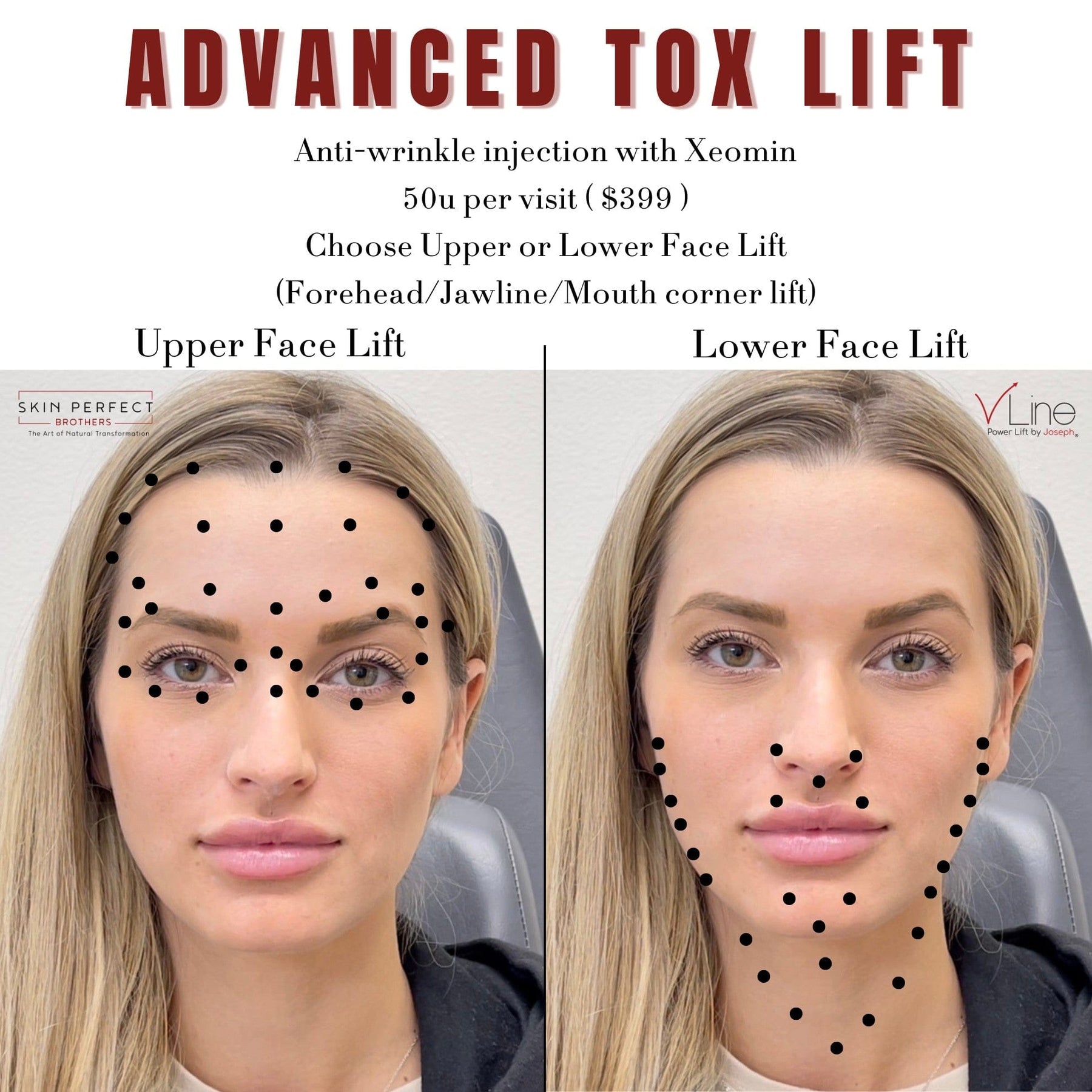 Tox Lift - Skin Perfect Brothers Powered by VLA