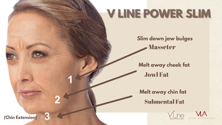 Masseter Injection - Skin Perfect Brothers Powered by VLA