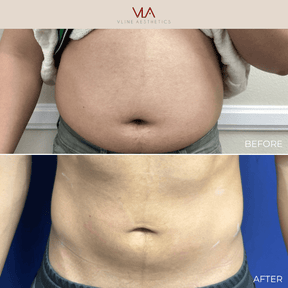 BMW Weight Loss Membership - Skin Perfect Brothers Powered by VLA