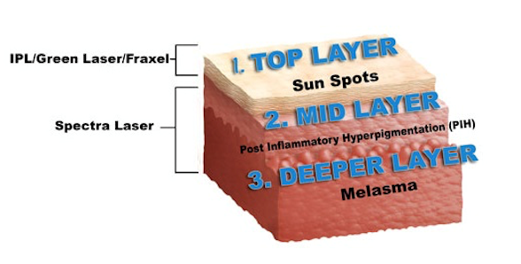 Cross-section showing the depth difference between PIH (shallower) and melasma (deeper dermis)