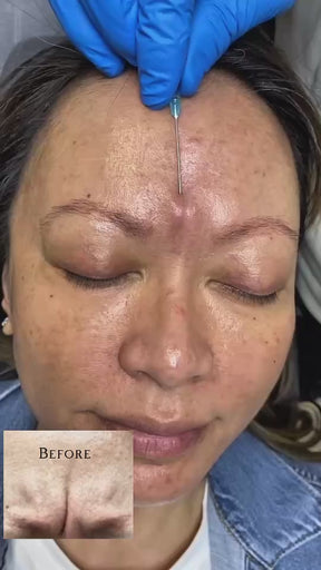 Champagne Botox