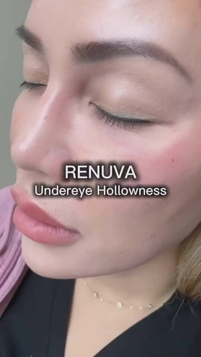 Renuva