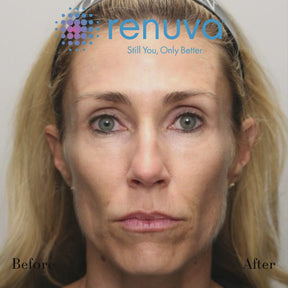 renuva