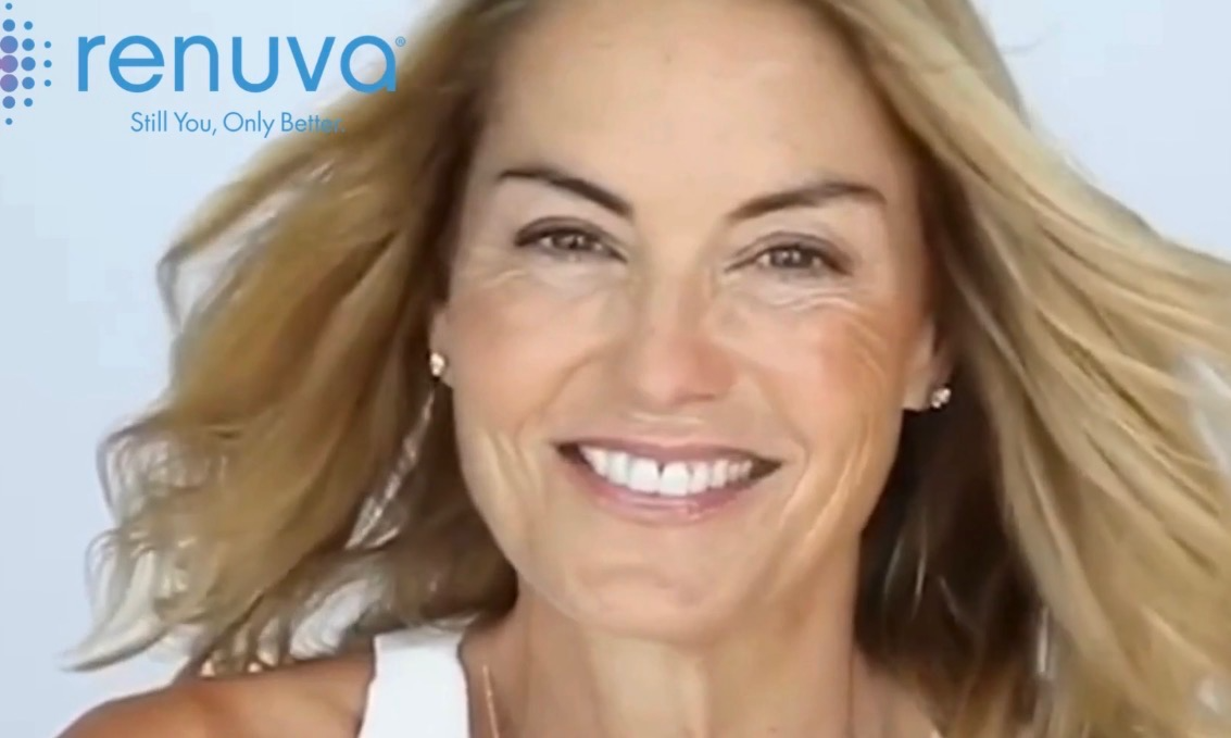 Renuva patient smiling after natural-looking facial volume restoration