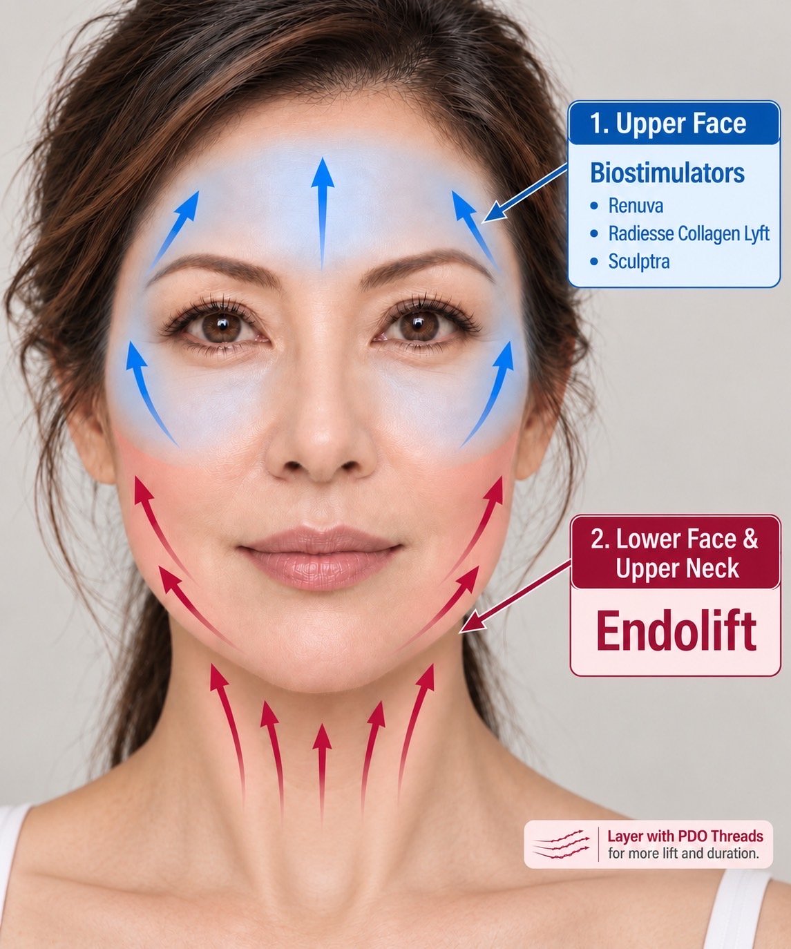 EndoliftX - Skin Perfect Brothers Powered by VLA