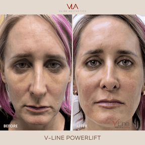 Collagen Lift - Skin Perfect Brothers Powered by VLA