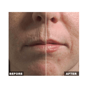 Fraxel Large Area - Skin Perfect Brothers Powered by VLA