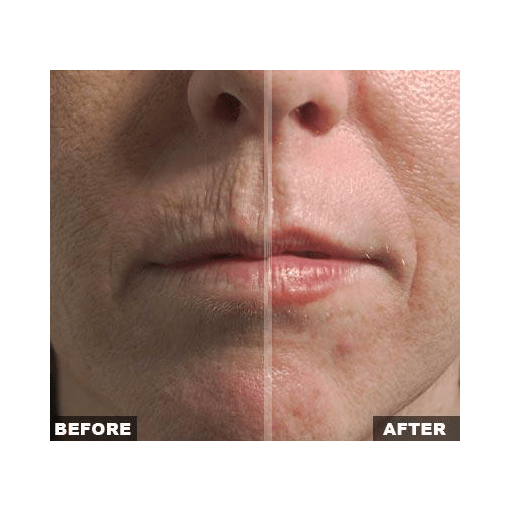 Fraxel Large Area - Skin Perfect Brothers Powered by VLA