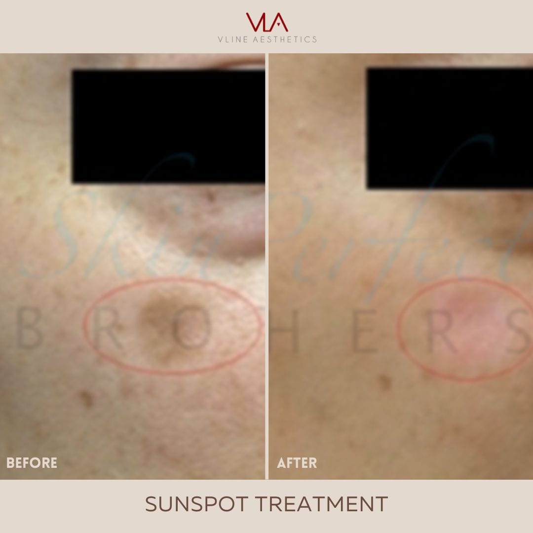 Sunspots / 1 Green Laser - Skin Perfect Brothers Powered by VLA
