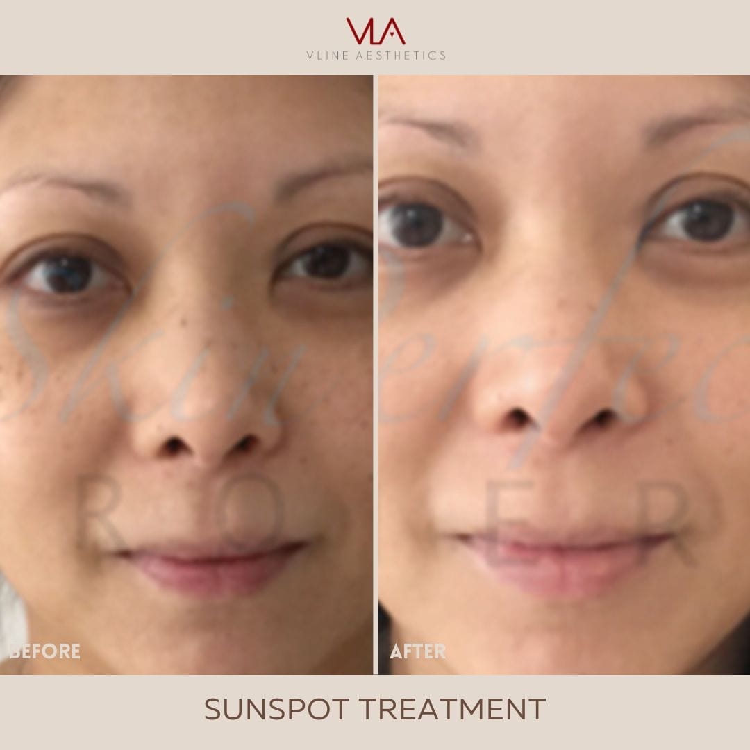 Sunspots / 1 Green Laser - Skin Perfect Brothers Powered by VLA