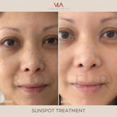 Sunspots / 1 Green Laser - Skin Perfect Brothers Powered by VLA