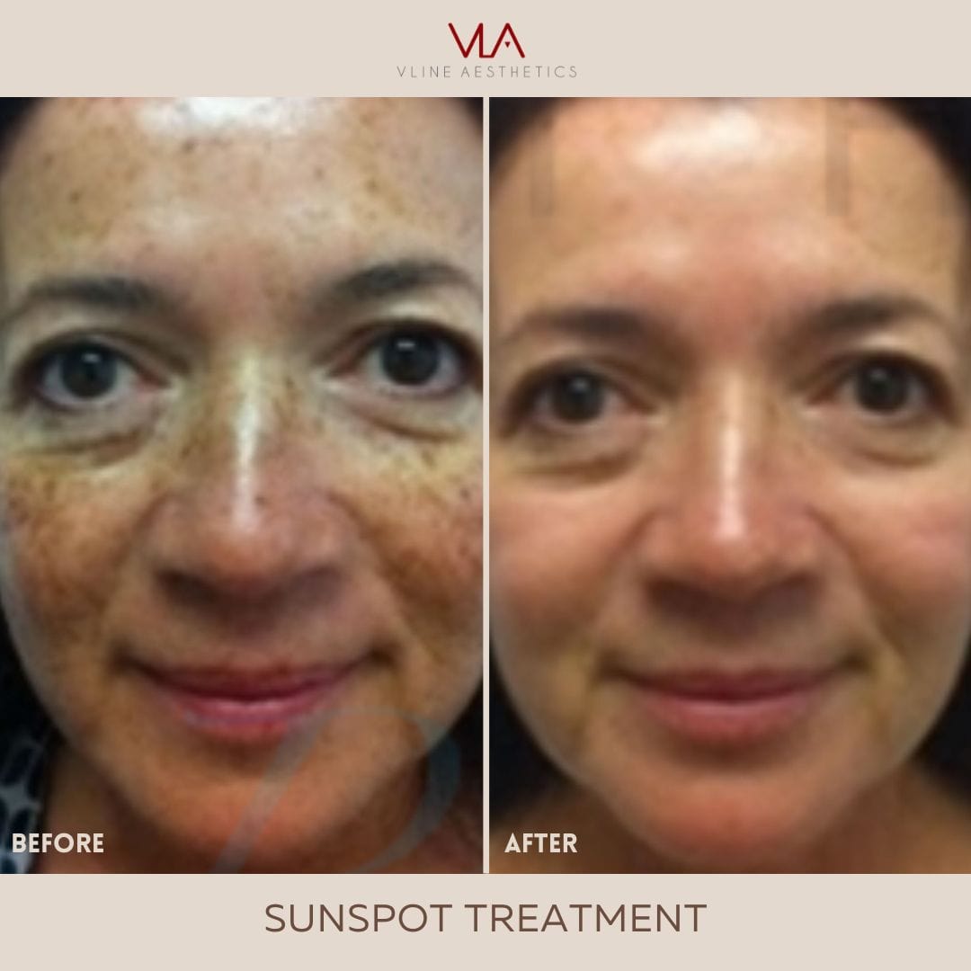 Sunspots / 1 Green Laser - Skin Perfect Brothers Powered by VLA