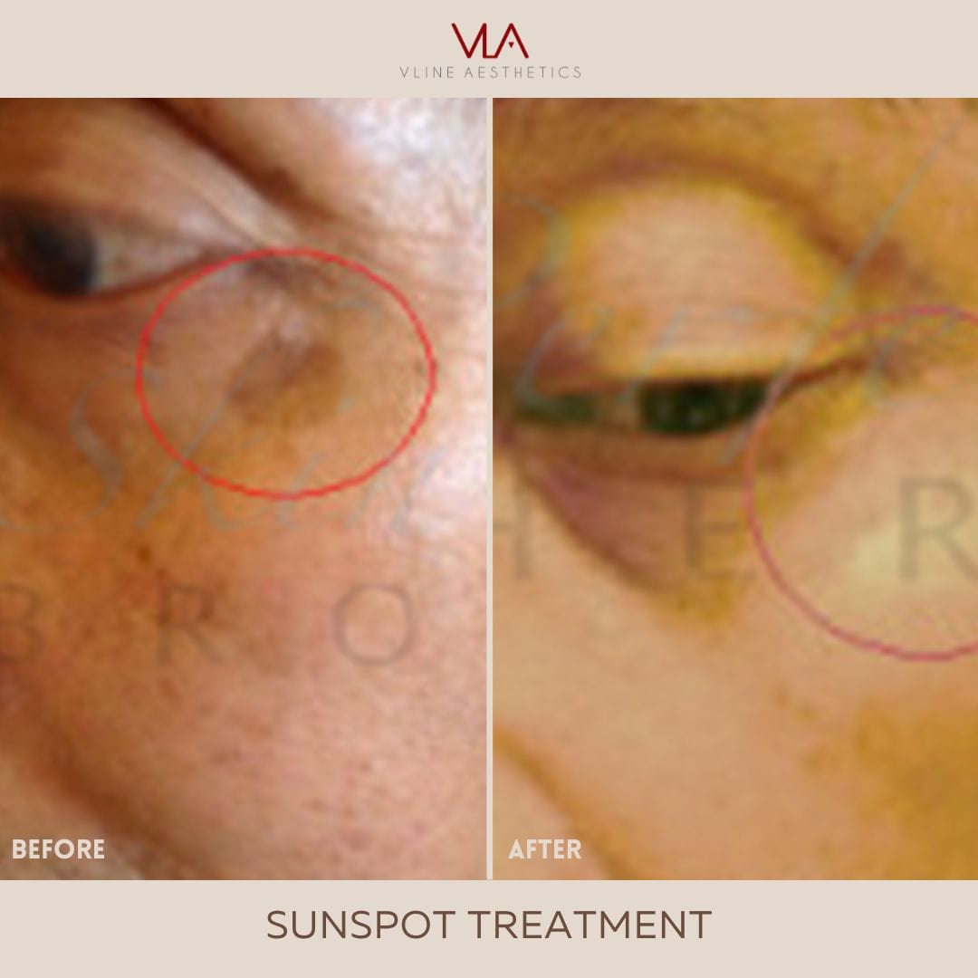 Sunspots / 1 Green Laser - Skin Perfect Brothers Powered by VLA