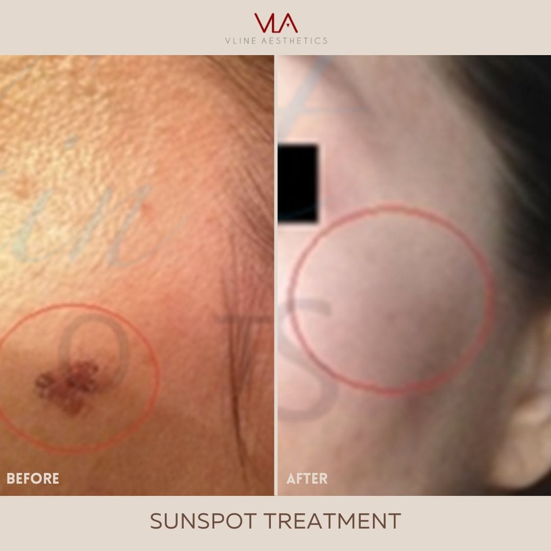 Sunspots / 1 Green Laser - Skin Perfect Brothers Powered by VLA