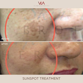 Sunspots / 1 Green Laser - Skin Perfect Brothers Powered by VLA