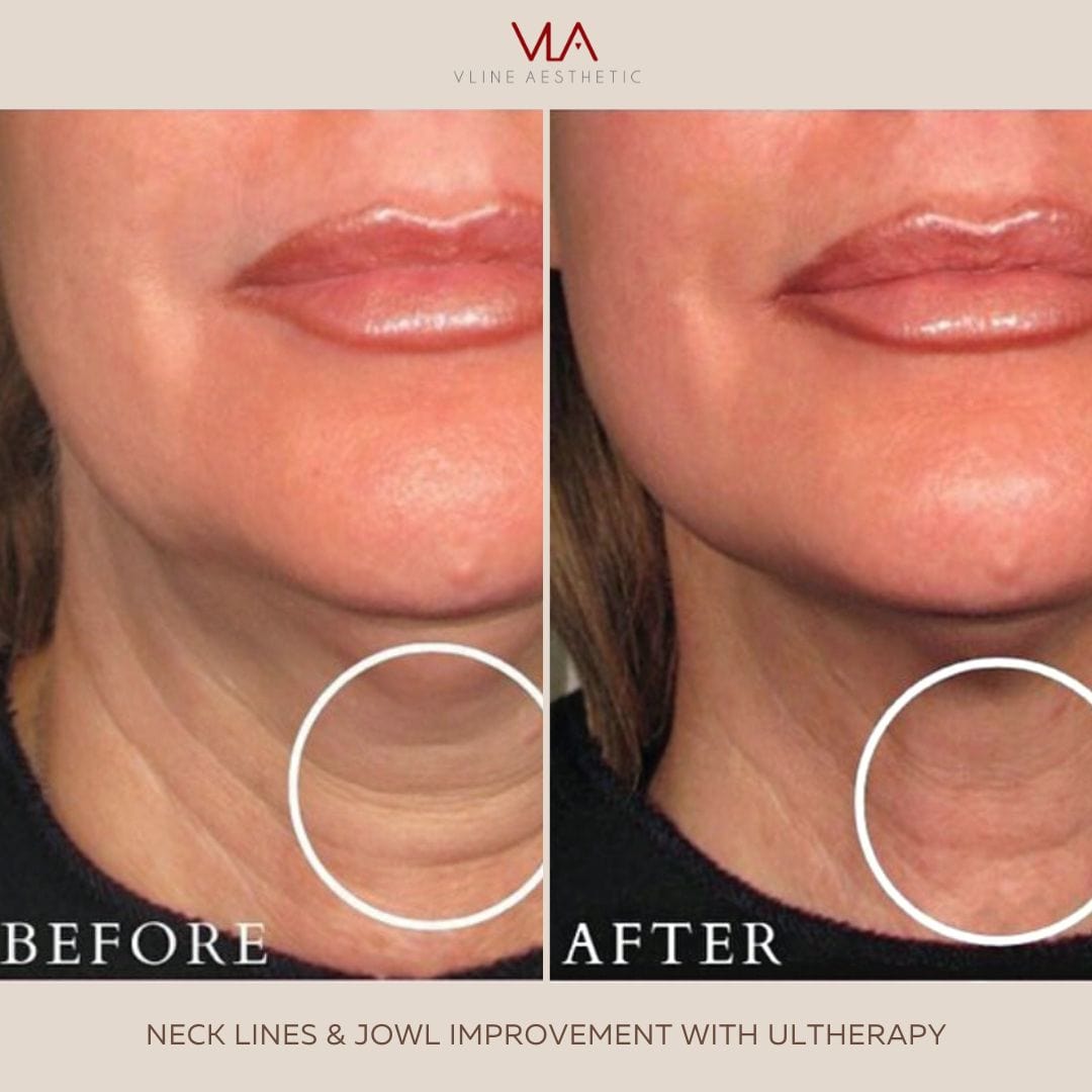 Ultherapy Prime Jawline Lift - Skin Perfect Brothers Powered by VLA