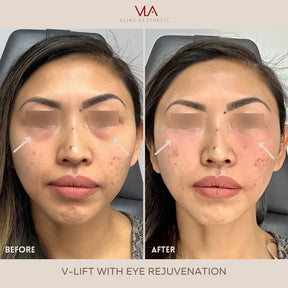 Collagen Lift - Skin Perfect Brothers Powered by VLA