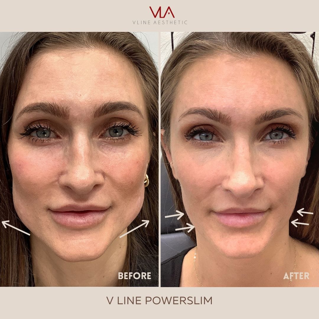 Masseter Injection - Skin Perfect Brothers Powered by VLA