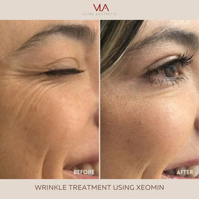 XEOMIN / JEUVEAU - Skin Perfect Brothers Powered by VLA
