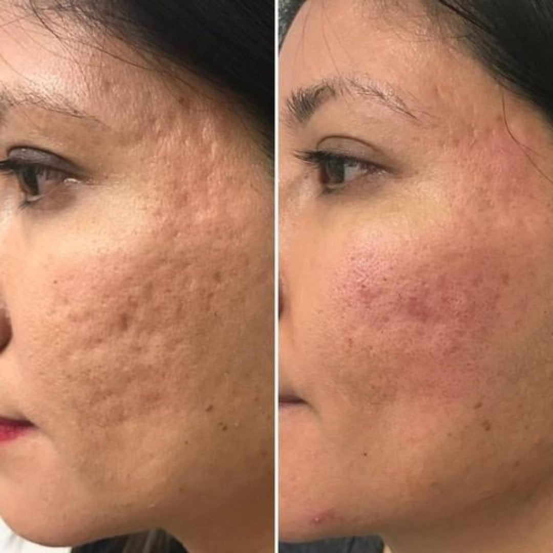Acne Scars / 1 Bellafill - Skin Perfect Brothers Powered by VLA