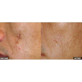 Fraxel Large Area - Skin Perfect Brothers Powered by VLA