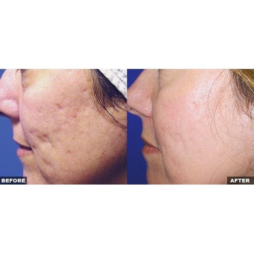 Fraxel Large Area - Skin Perfect Brothers Powered by VLA